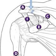A = Acromion, C = Clavicula, D = Humerus of bovenarmbeen, J = AC Gewricht, I = Coraco-acromiale band