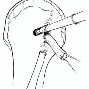 Reïnsertie van de geruptureerde bicepspees in het bovenarmbeen door middel van een interferentieschroef