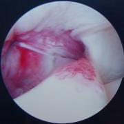 arthroscopie bicepspeestendinitis