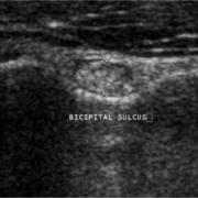 echografie normale biceps