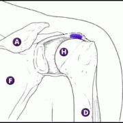 Calcificaties in de Rotator Cuffpezen