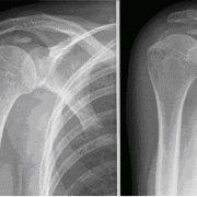 Radiografie van calcificatie in de supraspinatuspees