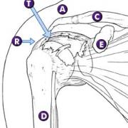A = Acromion, R = Rotator cuff, C = Clavicula of sleutelbeen, D = Humerus of bovenarmbeen, E = Processus coracoïdeus, F = Subscapularis spier, T = Scheur in de pees of pezen