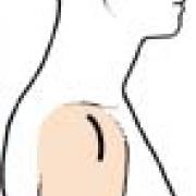 Incisie bij Mini-open ( =deltoid-split) toegang.