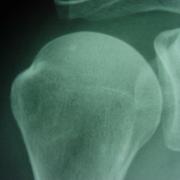 Radiografie van de schouder