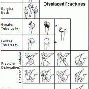 Neer-classificatie van de fracturen