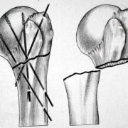 Pinning van fractuur