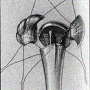 Schouderprothese na fractuur