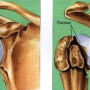 schouder aangetast door reuma en door onherstelbare gescheurde pezen, afgestorven humeruskop en breuk van de schouder